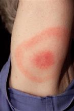 Bulls eye pathognomonic erythemauous rash tick bite