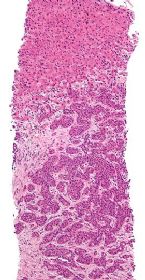 Adenocarcinoma liver metastasis