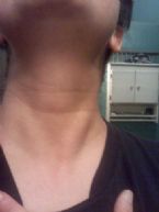 thyroid?