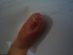 Pinkie nail and skin infection