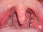 white spots on back of throat 1 ... (Click to enlarge)