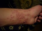 wrist rash