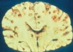 braincysts caused by pork tapeworm ... (Click to enlarge)