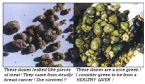 gallstones