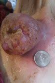 tumor 30 days later after 2 x bloodroot salve ... (Click to enlarge)