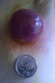 tumor armpit before bloodroot ... (Click to enlarge)