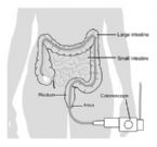 Colonoscopy Diagram