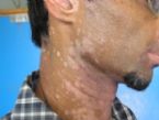 vitiligo patches on neck and face