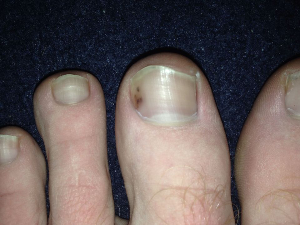 Cancer In The Toenail At Candida Dysbiosis Forum Topic 2175774