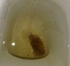 Mucus in stool