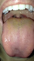 Yellow Tounge..Candida?