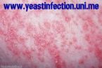 Yeast infection treatment