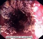 candida gut1