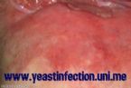 terrible yeast infection