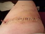 L Leg Laceration post-op ... (Click to enlarge)