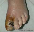 diabetic foot