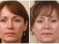 Do you know about Lower Eyelid surgery?