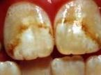 Severe dental fluorosis caused by excess fluoride ingestion