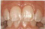 mild fluorosis