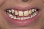 moderate fluorosis