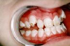 severe fluorosis - broken and chipped teeth