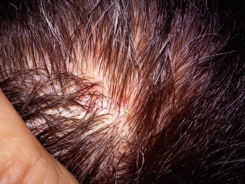 re-clear-scalp-for-seven-years-now-folliculitis-forum-1-7-2016-2295856