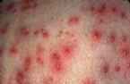 Folliculitis