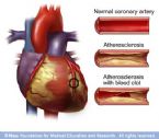 hb7 atherosclerosis