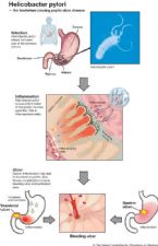 helicobacter inflammation of gastric mucosa ... (Click to enlarge)