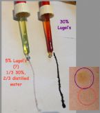 Lugol s comparisons