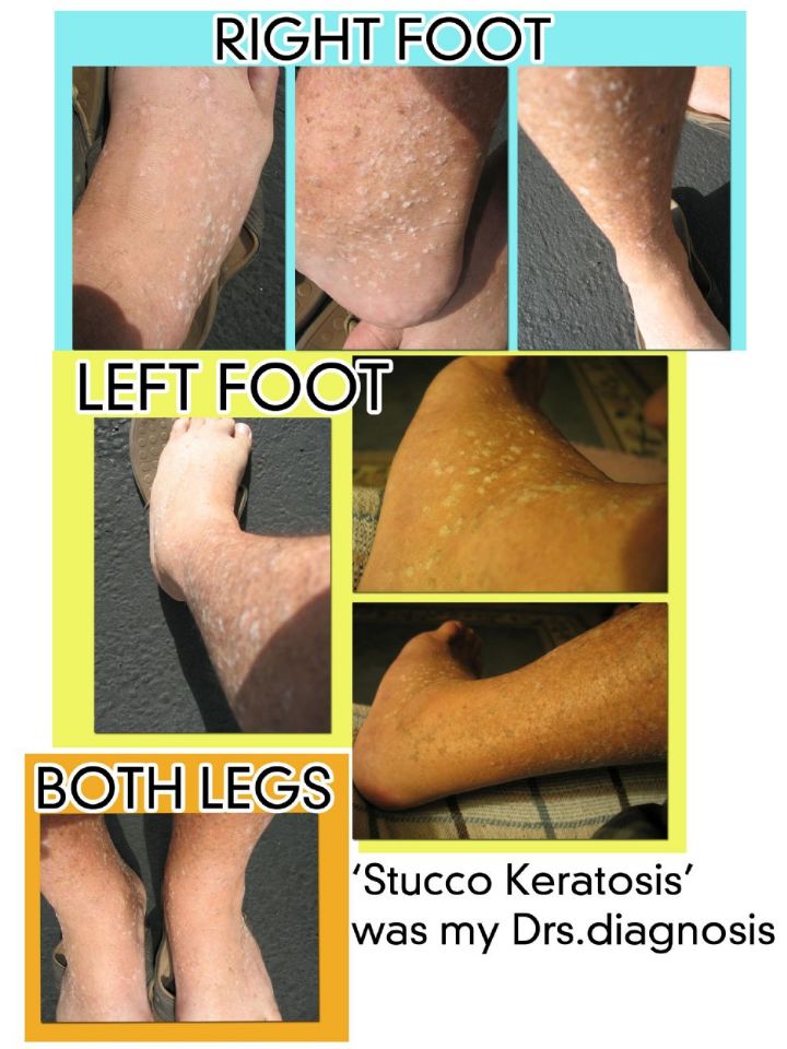 //www.curezone.org/upload/_K_L_Forums/Keratosis_Pilaris/Stucco_feet_collage_8_5x11.jpg