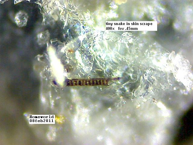 //www.curezone.org/upload/_M_Forums/Morgellons/FHW/Skin/skinsnake_8feb11.jpg