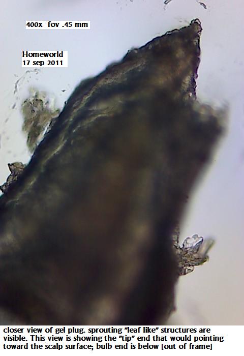 //www.curezone.org/upload/_M_Forums/Morgellons/FHW/hair_and_scalp/gels/scalplug3_17sep11.jpg