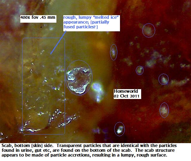 //www.curezone.org/upload/_M_Forums/Morgellons/FHW/scabs/scabparticles2oct11.jpg