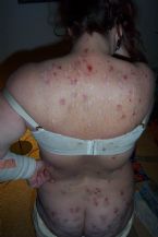 morgellons infection