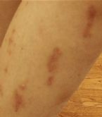 //www.curezone.org/upload/_M_Forums/Morgellons/tn-Skin_Lesions2.jpg