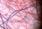 morgellons fibres