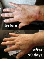 My hand before and after 90 days