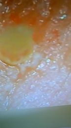 another of my morgellons skin problems