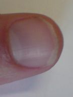 nail problem