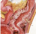 DiverticulitisCloseDrawing