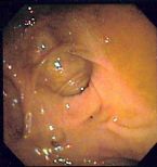 DiverticulosisCloseUpEndo