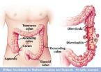 Diverticulosisanddiverticulitis