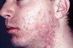 Folliculitis MRSA 004