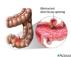 diverticulipocket