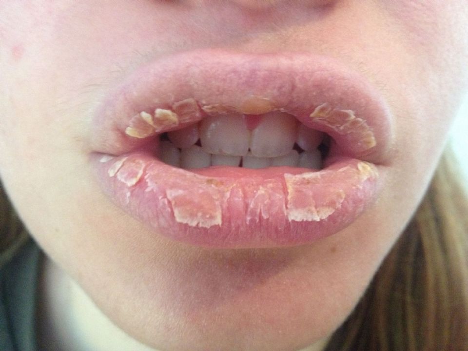 chapped-lips-causes-symptoms-and-remedies-neosporin