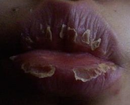 //www.curezone.org/upload/_O_P_Forums/Peeling_Lips/GETTING_BETTERxx.jpg