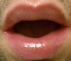 White Spots On Upper Lip ... (Click to enlarge)