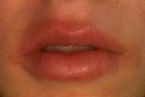 Rash around lips- red and painful ... (Click to enlarge)