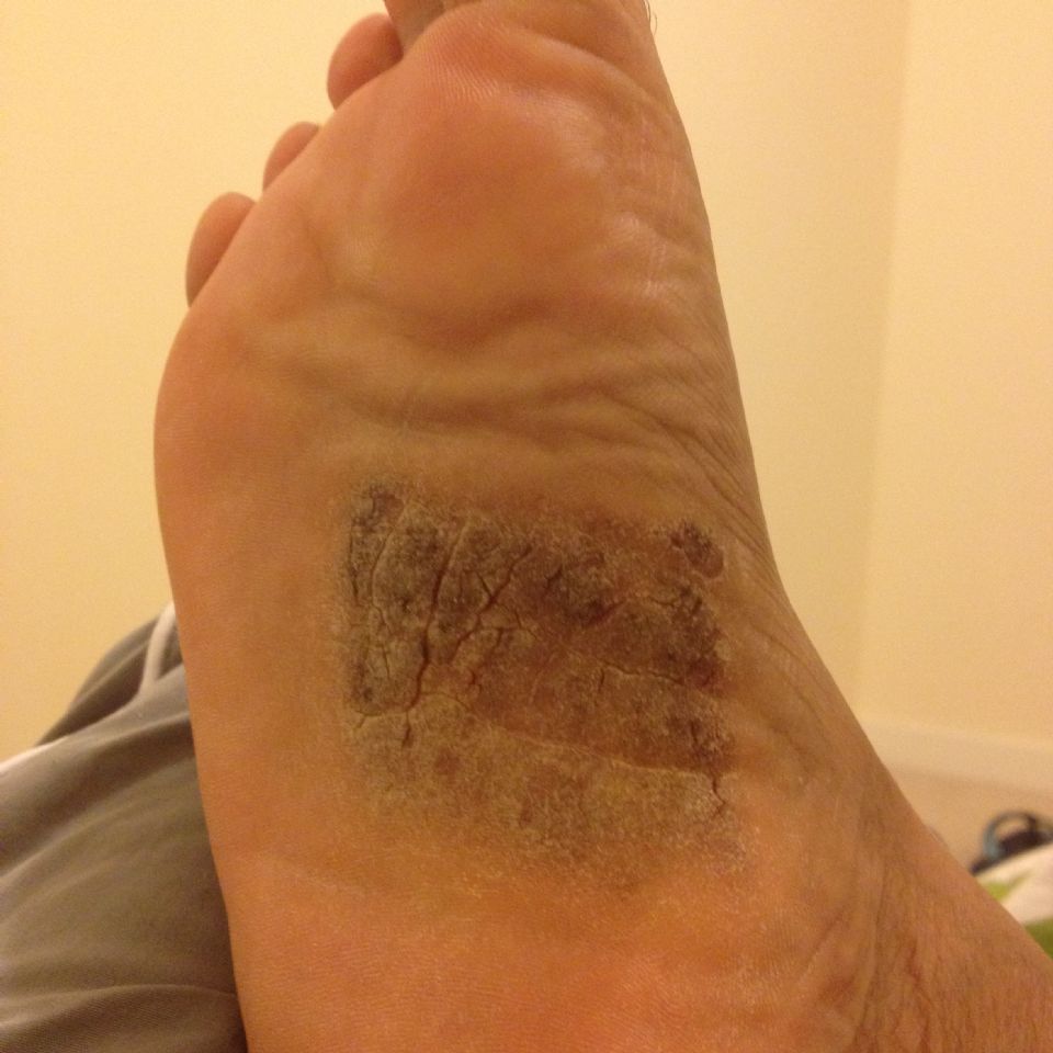 Itchy Dry Flaky Soles At Psoriasis Support Forum Topic 2209849